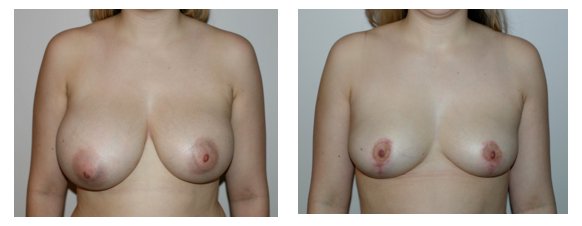 Asymmetric Breast Reduction