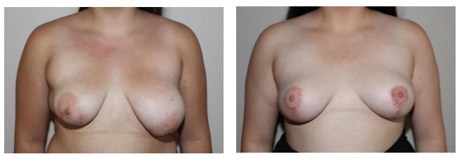  Mastopexy and Breast Reduction