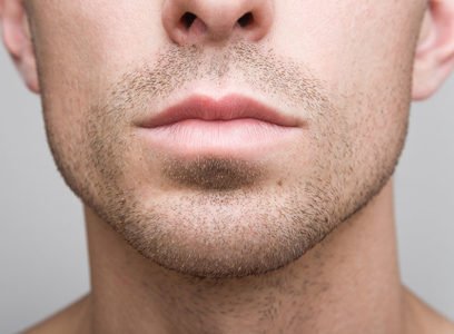 chin-augmentation-surgery for men in Melbourne, custom chin implants vs sliding genioplasty