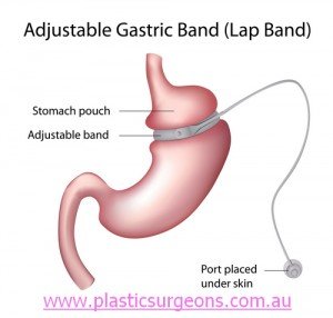 Image-gastric-lap-banding