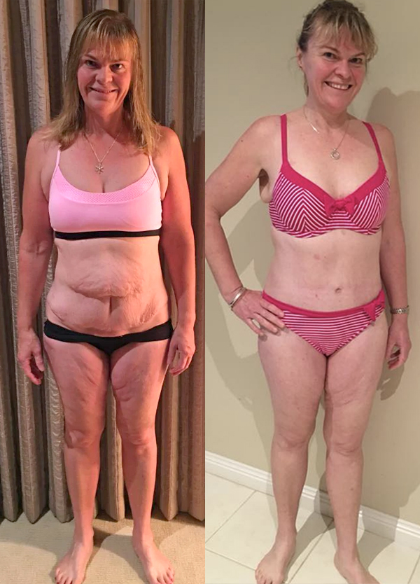 Before And After Pictures Of A Tummy Tuck