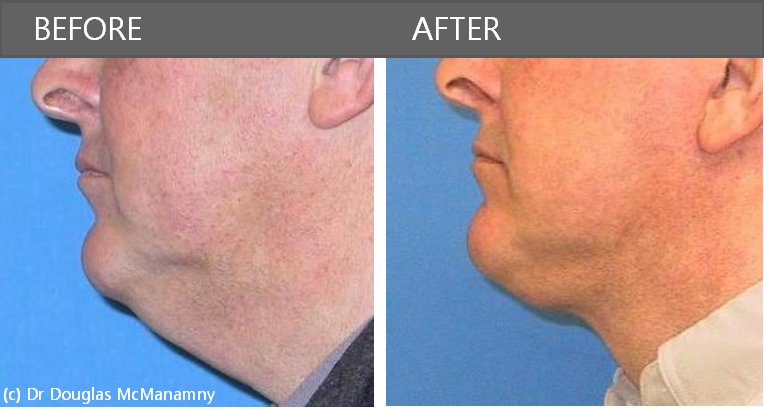 Photo of Neck Lift Surgery Facelift Surgery re Types of Facelifts