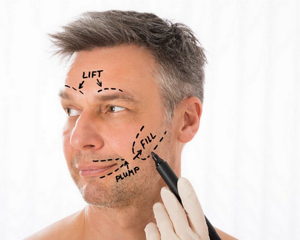 Facelift Surgery - what to expect