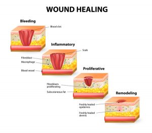 wound healing and scars after surgery