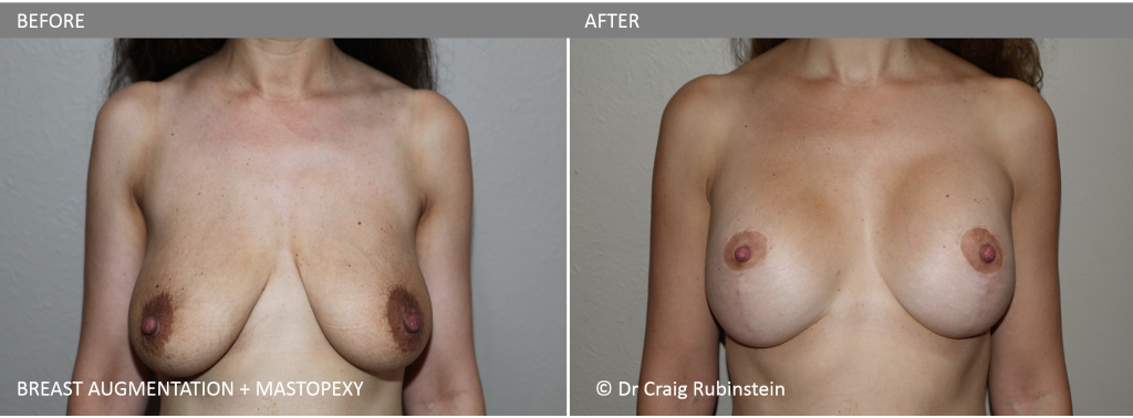 Breast Augmentation; Mastopexy; Before and After; Melbourne; Surgery