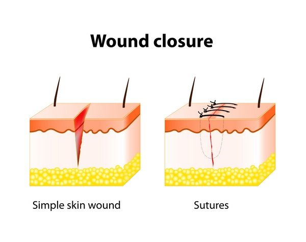 sutures after breast implants wound healing process with help surgical suture.