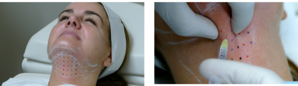 double chin fat reduction injections kybella grid-under-chin-dots