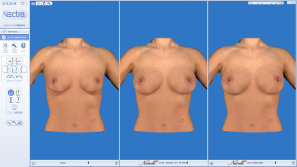 vectra 3D Imaging breast augmentation