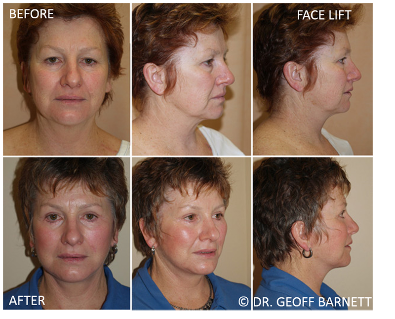 face-lift-surgery-dr-geoff-barnett-before-and-after-melbourne