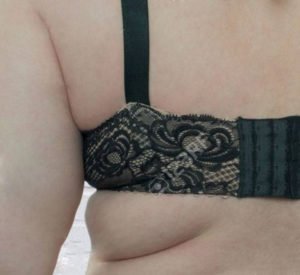 back-fat-armpit-fat-liposuction-arms