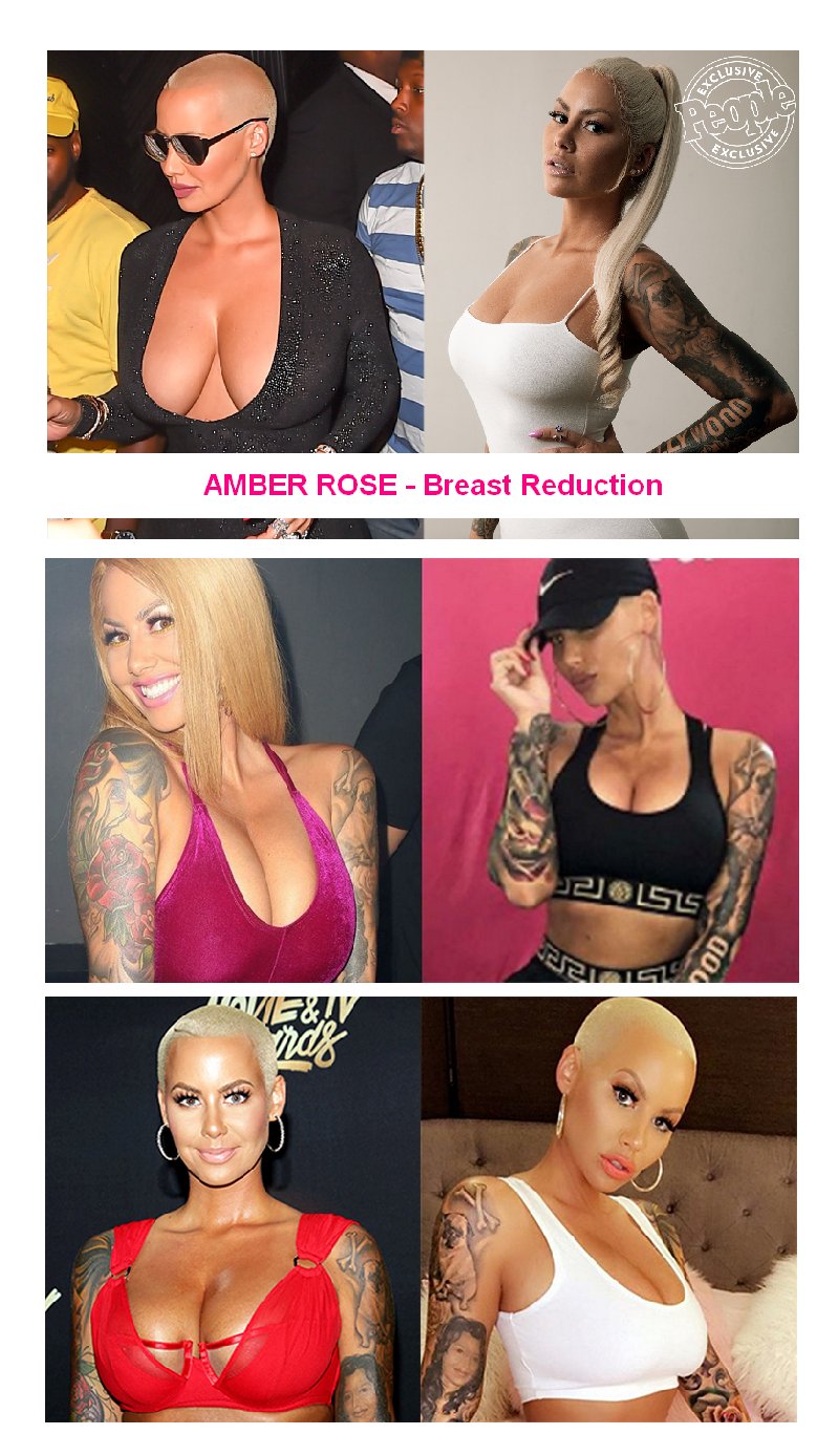 Telling friends you're having cosmetic surgery social-media-instagram-amber-rose-breast-reduction