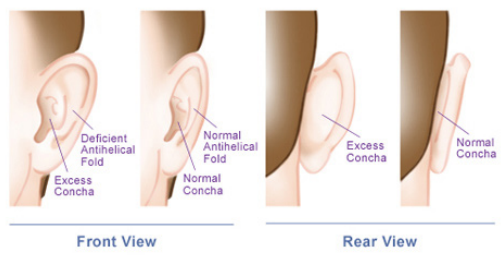 ear-pinning-surgery, Otoplasty surgery a Plastic Surgeon can help if your earlobes are sticking out too much.