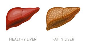 bmi-fatty-liver-surgery-plastic-surgeon - fatty liver disease. illustration of a healthy and a fatty liver