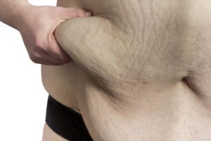 tummy-fat-after-weight-loss