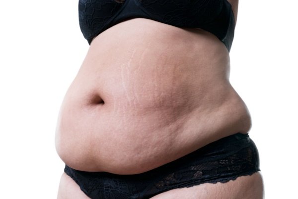 too fat for Tummy Tuck Surgery Melbourne
