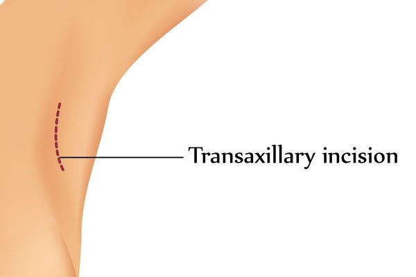 Transaxillary Breast Enlargement