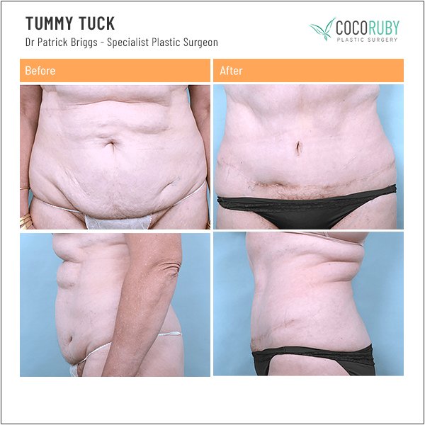 tummy-tuck-before-and-after-dr-patrick-briggs-49