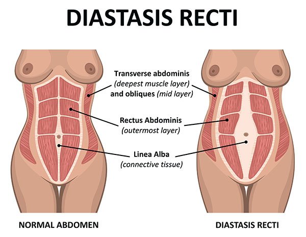 diastasis-recti-abdominoplasty-tummy-tuck-melbourne