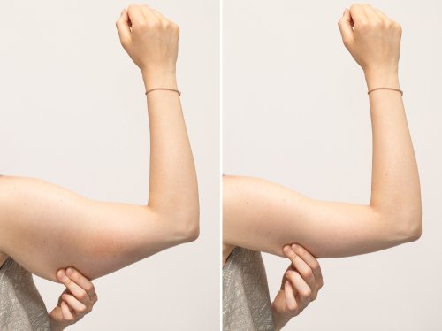 Reducing Flabby Upper Arms With Brachioplasty Surgery