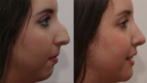 Dr Stephen Kleid Rhinoplasty before and after
