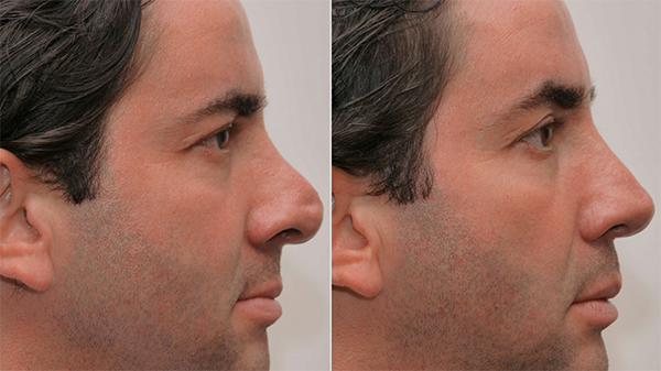 Dr Stephen Kleid Rhinoplasty before and after