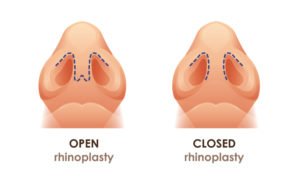 open vs closed rhinoplasty