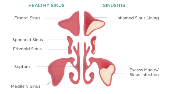Sinus Surgery sunusitis