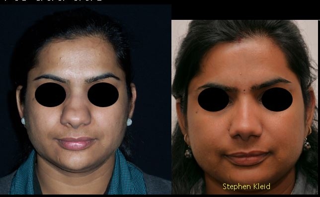 Ethnic Nose Job – Features of Non-Caucasian Noses | Plastic Surgery