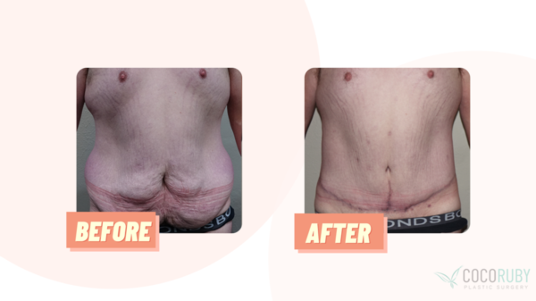 Coco Ruby Blog - Before and After Belt Lipectomy