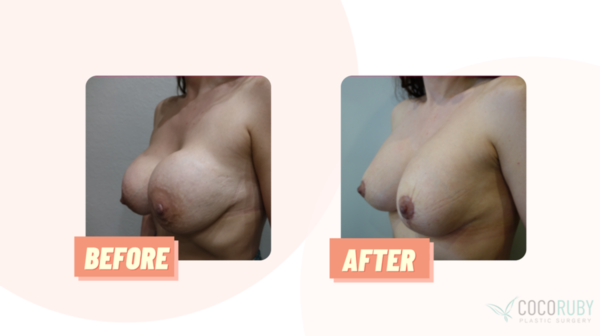 Coco Ruby Blog - Before and After Mandatory Breast Implant Removal Image