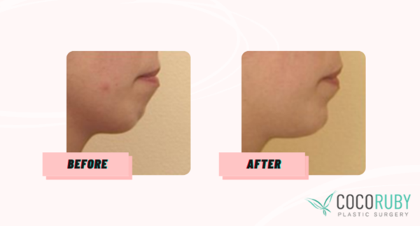 Coco Ruby Plastic Surgery Blog - claim my Chin Surgery on Medicare Before and After Image