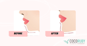 Coco Ruby Plastic Surgery Blog - claim my Chin Surgery on Medicare Before and After Image Illustration