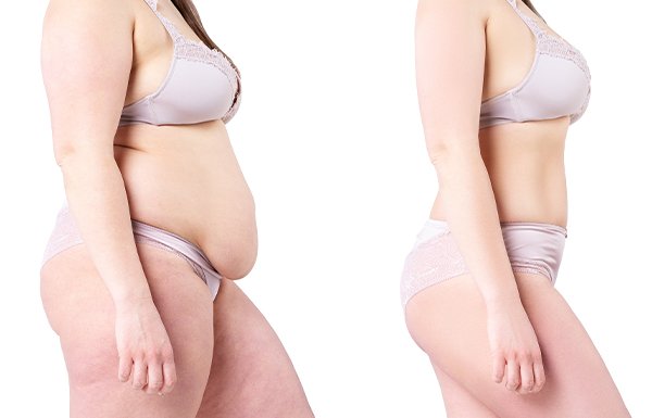 Tummy-Tuck Pros and Cons