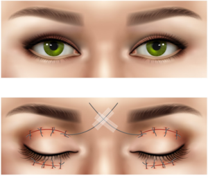 Coco Ruby Plastic Surgery Blog Eyelid Anatomy Surgery Before and After Illustration