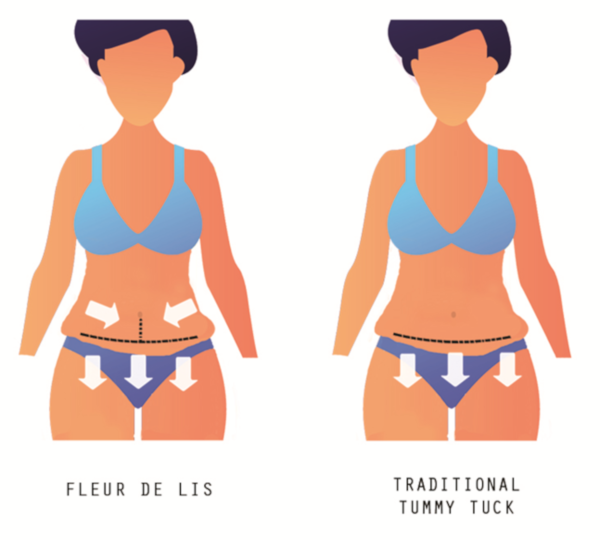 Coco Ruby Plastic Surgery Differentiating Fleur De Lis with Traditional Tummy Tuck