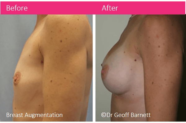 breast augmentation implants dr Geoff Barnett before after photo