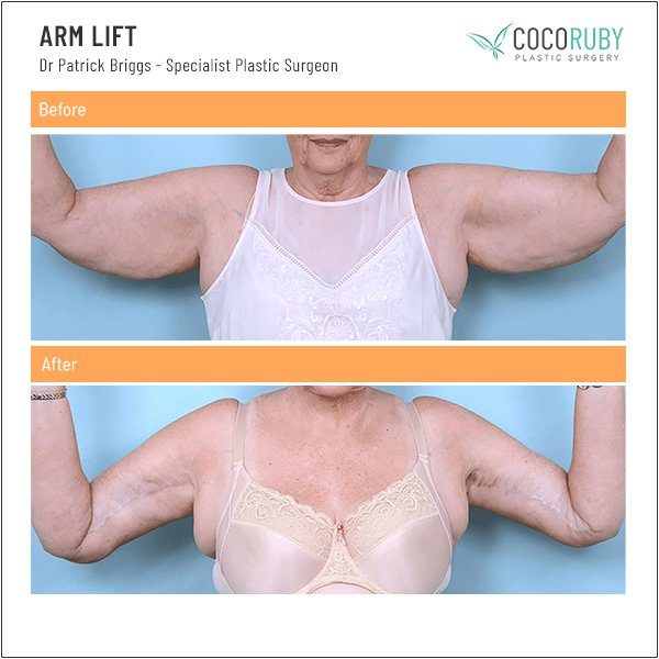 arm-lift-before-and-after-dr-patrick-briggs-14