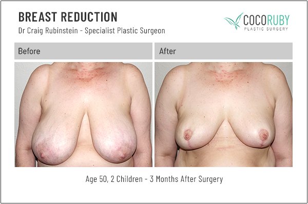 dr-craig-rubinstein-breast-reduction-30
