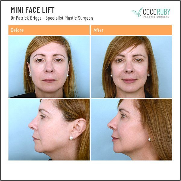 mini-face-lift-before-and-after-dr-patrick-briggs-91