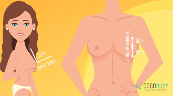 Coco Ruby Plastic Surgery - What make beautiful breast blog Breast Angle and Distribution Illustration Image Scaled
