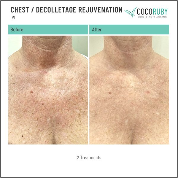 chest-decolletage-rejuvenation-before-and-after-1