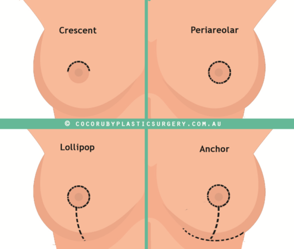 Lejour Lollipop Vs Anchor Incision Scar Technique for Breast Reduction & Lift Image Illustration