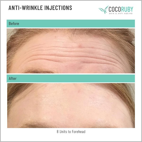 anti-wrinkle-injections-before-and-after-13