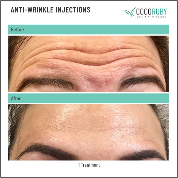 anti-wrinkle-injections-before-and-after-16