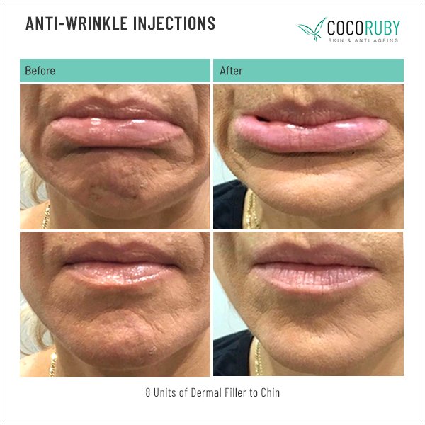 anti-wrinkle-injections-before-and-after-28