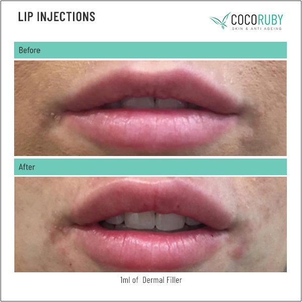 lip-injections-before-and-after-19