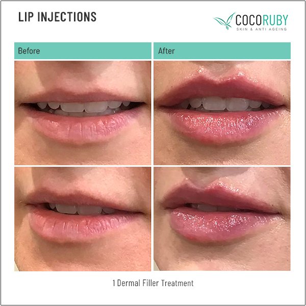 lip-injections-before-and-after-24