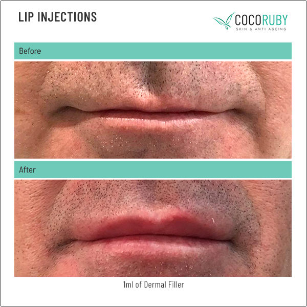 lip-injections-before-and-after-30