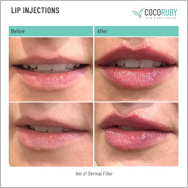 lip-injections-before-and-after-32