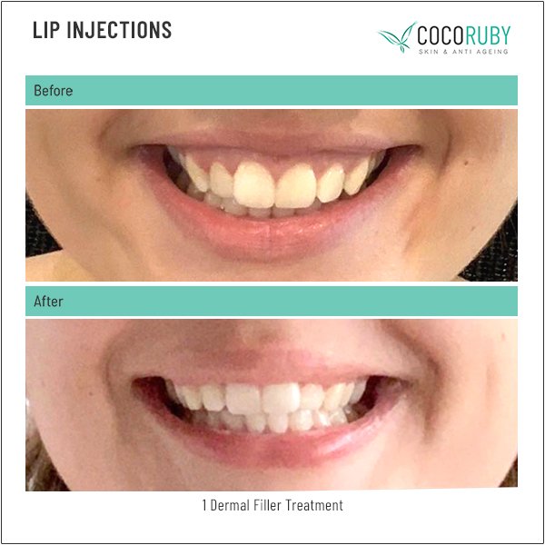 lip-injections-before-and-after-36